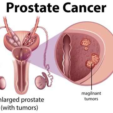 Prostate Cancer.