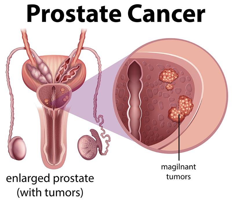 Prostate Cancer.