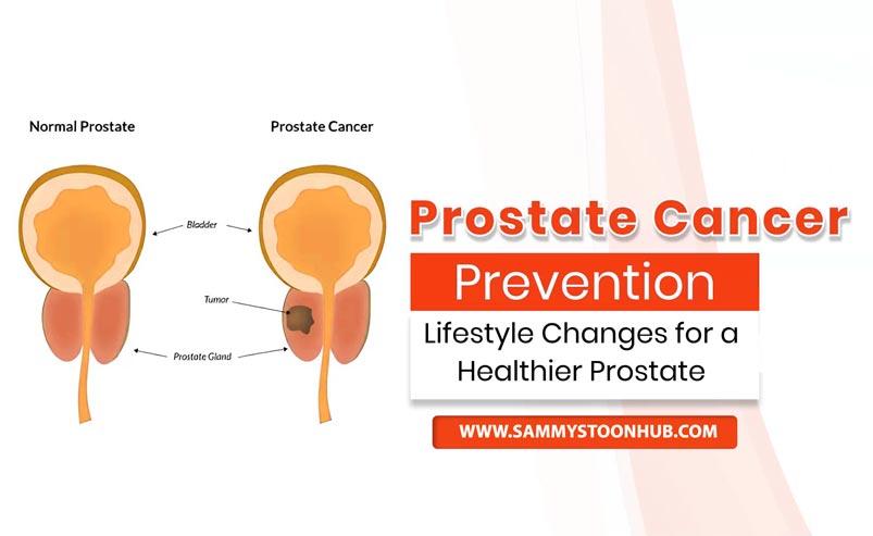 Prostate Cancer Prevention: A Guide to Risk Reduction.